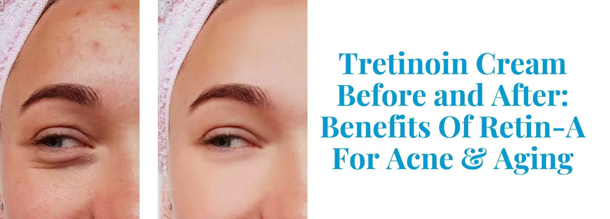 Tretinoin cream before and after beenfits of retin-a for acne & aging